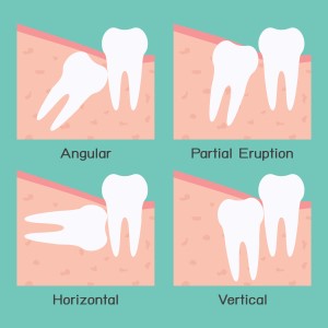 Illustration of teeth removal