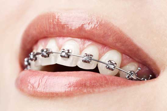 Braces attached to the teeth