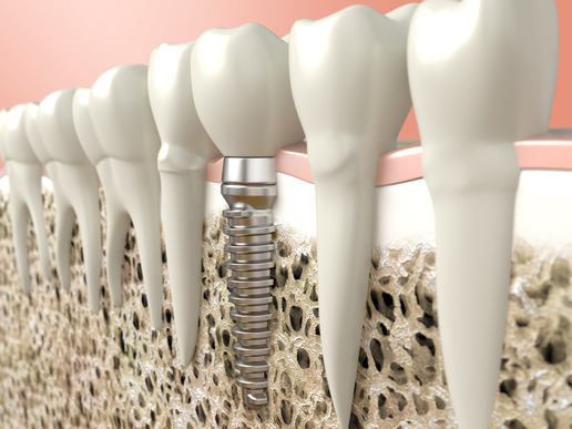 high resolution 3d rendering of a dental implant