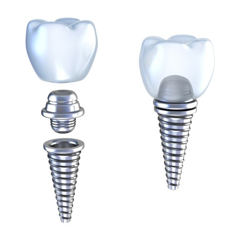 Illustration of tooth replacement