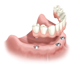 Illustration of dental implant