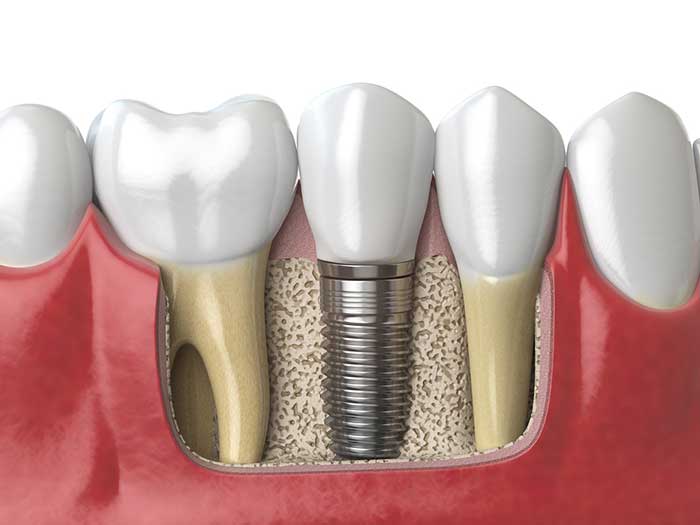 Dental Implants