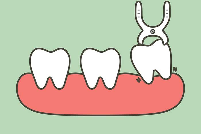 Illustration of teeth extraction 