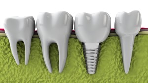 Dental Implants