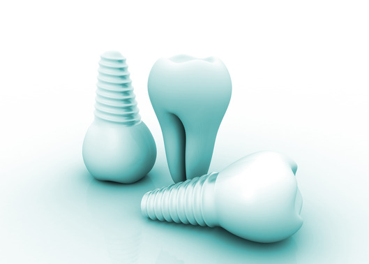 Dental implant