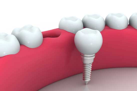 Dental Implants