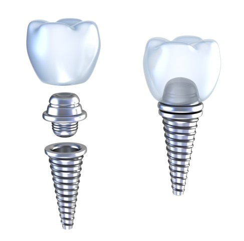 Illustration of tooth replacement