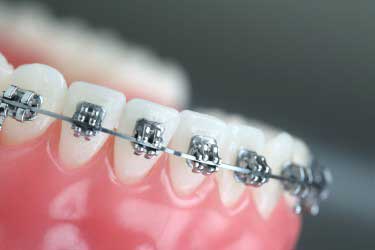 Braces attached to the teeth